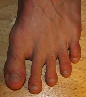 Sprained toe facts