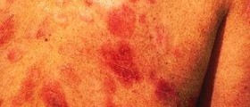 Staging and survival rate of Kaposi's sarcoma