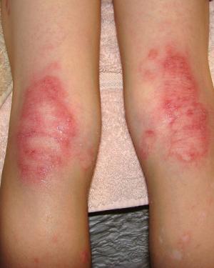 Staph infection causes and symptoms | General center | SteadyHealth.com