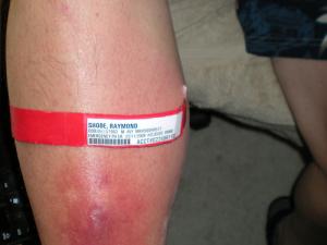 Staph infections - staph infection treatment and symptoms