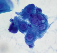 STD facts - Genital herpes