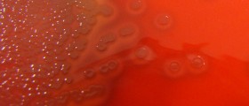 Meningococcal Disease: Meningitis treatment and prevention