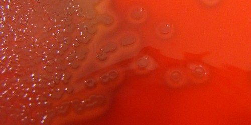 Meningococcal Disease: Meningitis treatment and prevention