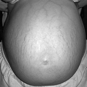 Stretch marks: prevention and treatment during pregnancy