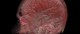 Huntington's Disease: Progressive Neurodegenerative Genetic Disorder