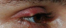 Stye - eye infection