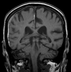 Subdural hematoma symptoms, causes and diagnosis