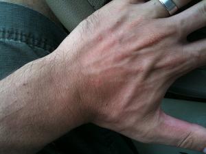 Sun poisoning symptoms, causes and treatment