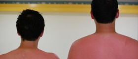 Ten Easy Home Remedies For Sunburn
