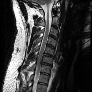 Surgery for cervical herniated disc