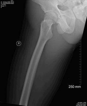 Surgery for femur fracture