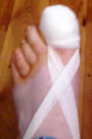 Surgery for ingrown toenails