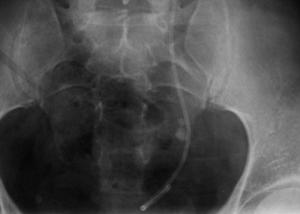 Surgery for kidney stones