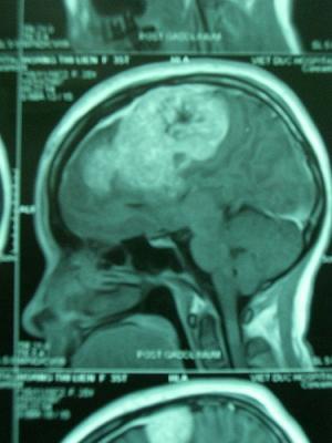 Surgery for meningioma