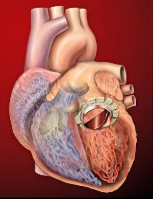 Surgery for mitral valve prolapse
