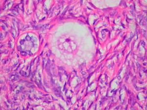 Surgery for ovarian cancer