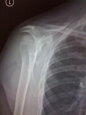Surgery for rotator cuff injury