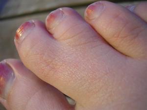 Surgery for syndactyly
