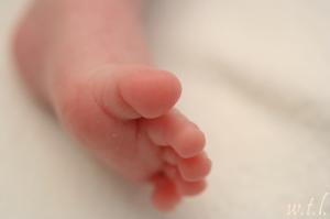 Surgery for webbed toes