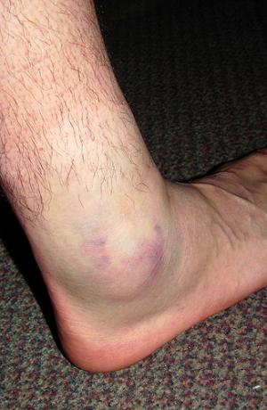 Swollen ankles fluid retention | General center | SteadyHealth.com