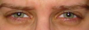 Swollen eyelids in the morning