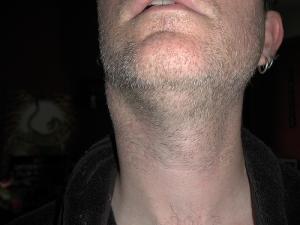 Swollen glands in neck