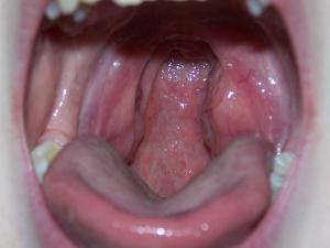 Swollen tonsils symptoms, remedies and treatment