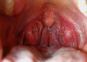 Swollen tonsils treatment