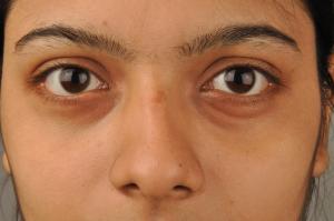 Swollen Under Eye Causes | General Center | SteadyHealth.com