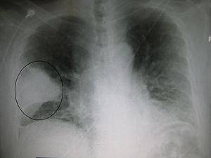 Symptoms and treatment of walking pneumonia in children
