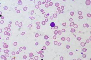 Symptoms of anemia