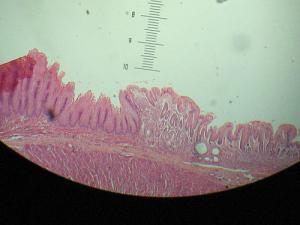 Symptoms of barrett's oesophagus