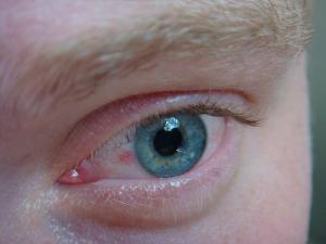 Download Symptoms of bloodshot eyes | General center | SteadyHealth.com