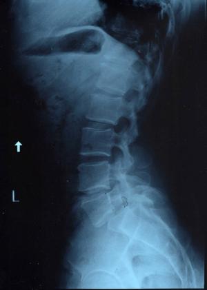 Symptoms of cervical spondylosis