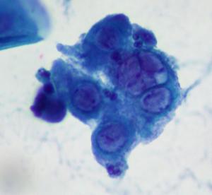 Symptoms of genital herpes