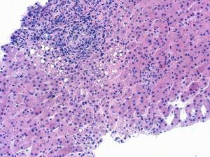 Symptoms of hepatitis