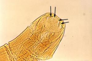 Symptoms of hookworm