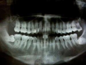 Symptoms of pyorrhea