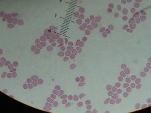 Symptoms of sickle cell anemia