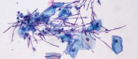 Symptoms of systemic Candida infection