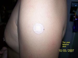 Symptoms of tetanus