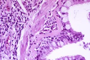 The difference between asthma and bronchitis