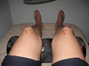 The history of acupuncture