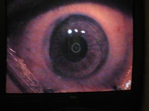 The lasik procedure: a thorough explanation