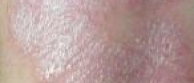 The natural way to treat dermatitis and psoriasis