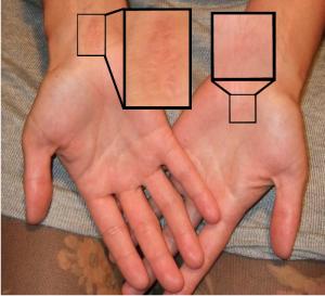 Therapy for carpal tunnel