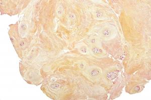 Therapy for degenerative disc disease