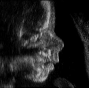 Therapy for fetal alcohol syndrome