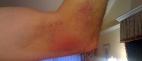 Therapy for fractured elbow