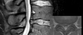 Therapy for herniated disc